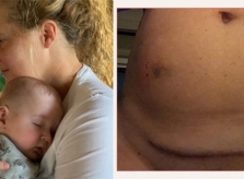 Nữ diễn viên Amy Schumer tiết lộ vết sẹo mổ đẻ