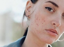 4 vấn đề da có thể gặp vì lười thay vỏ gối