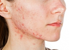 Cách chăm sóc da mụn nội tiết