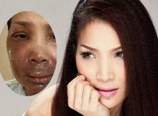 Hồng Ngọc sau 2 tháng gặp tai nạn bỏng