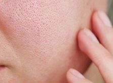 Nguyên nhân phổ biến khiến lỗ chân lông to, da sần sùi