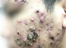 Khuôn mặt chi chít mụn mủ sau khi dùng kem trị trứng cá mua qua mạng