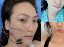 Phương Anh Đào méo miệng sau mổ tuyến giáp