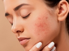Vị trí nổi mụn cảnh báo vấn đề sức khỏe